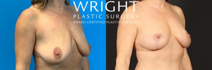 Before & After Breast Lift Case 461 Right Oblique View in Little Rock, Arkansas