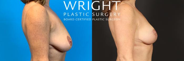 Before & After Breast Lift Case 461 Right Side View in Little Rock, Arkansas