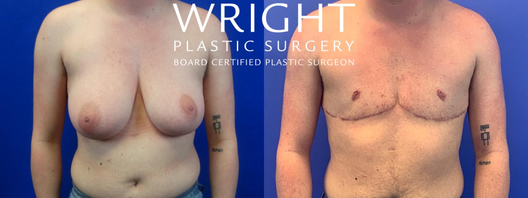 Before & After FTM Top Surgery Case 169 Front View in Little Rock, Arkansas