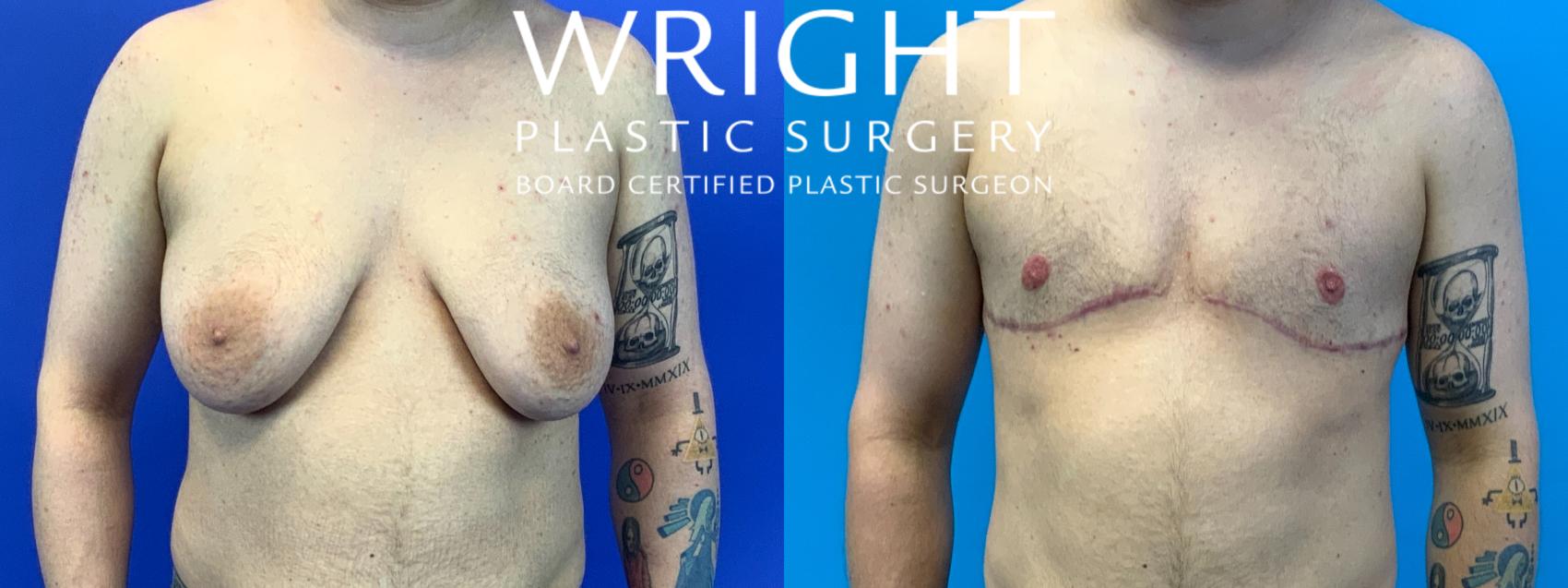 Before & After FTM Top Surgery Case 201 Front View in Little Rock, Arkansas