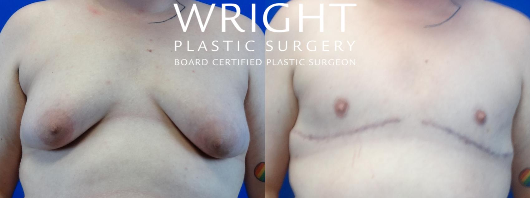 Before & After FTM Top Surgery Case 82 Front View in Little Rock, Arkansas