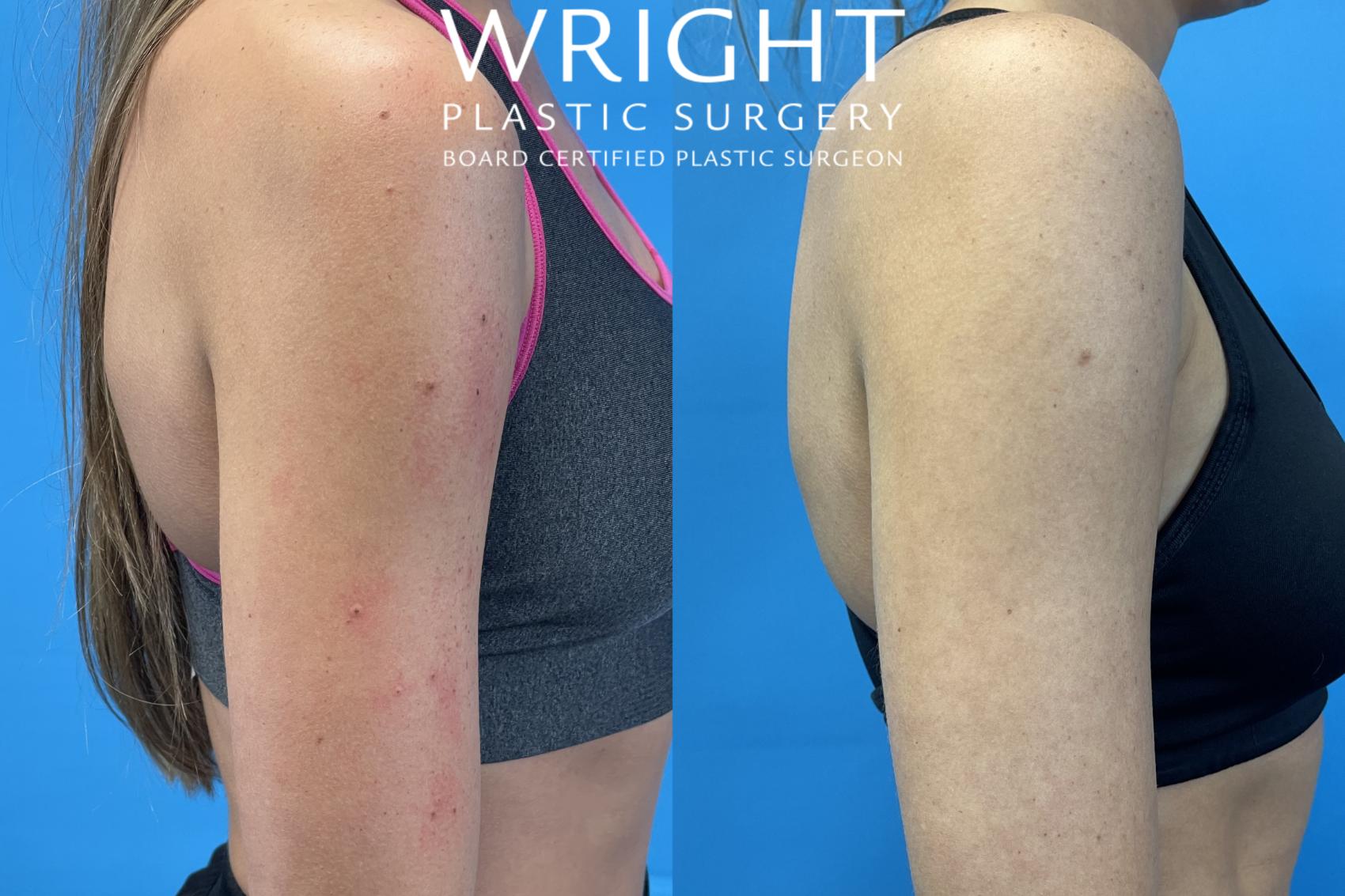 Before & After Laser Skin Resurfacing Case 351 Right Side View in Little Rock, Arkansas