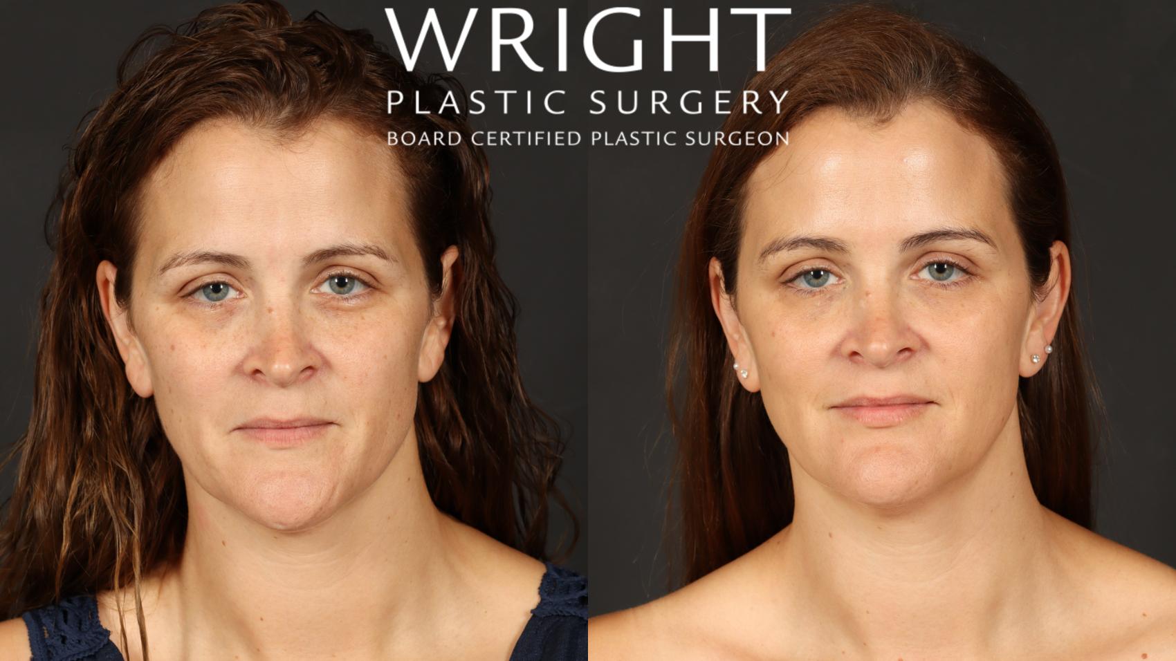 Before & After Laser Skin Resurfacing Case 581 Front View in Little Rock, Arkansas