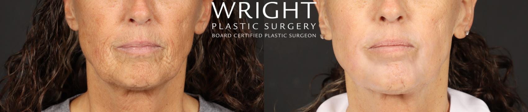 Before & After Laser Skin Resurfacing Case 600 Front View in Little Rock, Arkansas