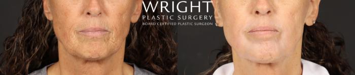 Before & After Laser Skin Resurfacing Case 600 Front View in Little Rock, Arkansas