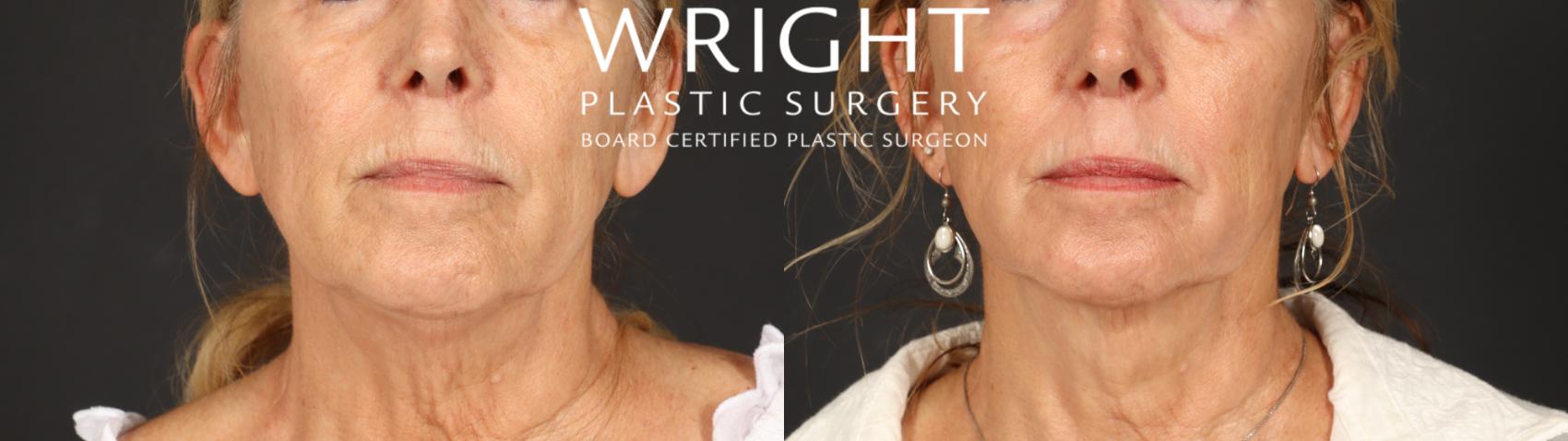 Before & After Laser Skin Resurfacing Case 699 Front View in Little Rock, Arkansas