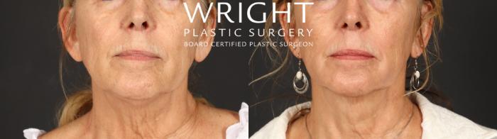 Before & After Laser Skin Resurfacing Case 699 Front View in Little Rock, Arkansas
