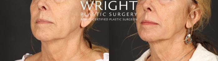 Before & After Laser Skin Resurfacing Case 699 Left Oblique View in Little Rock, Arkansas