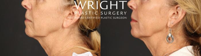 Before & After Laser Skin Resurfacing Case 699 Left Side View in Little Rock, Arkansas
