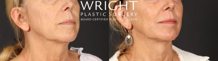 Before & After Laser Skin Resurfacing Case 699 Right Oblique View in Little Rock, Arkansas