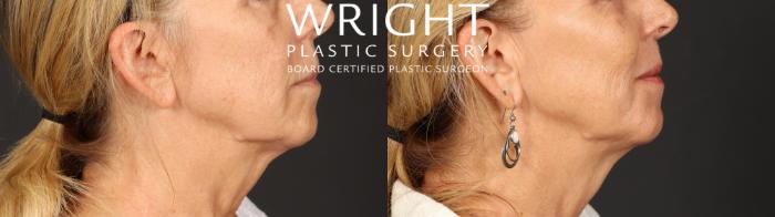 Before & After Laser Skin Resurfacing Case 699 Right Side View in Little Rock, Arkansas