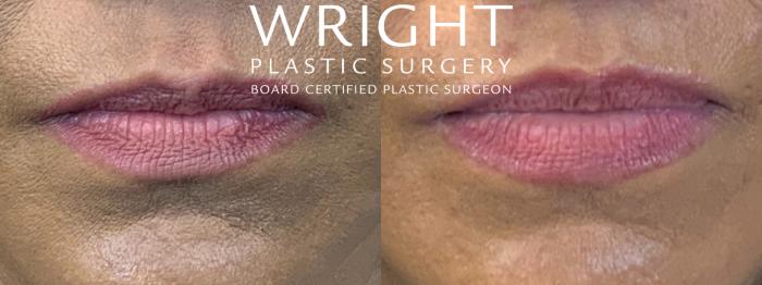 Before & After Lip Lift Case 236 Front View in Little Rock, Arkansas