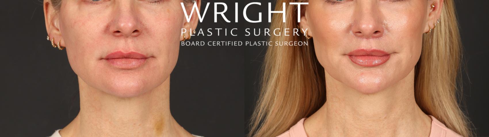 Before & After Lip Lift Case 598 Front View in Little Rock, Arkansas