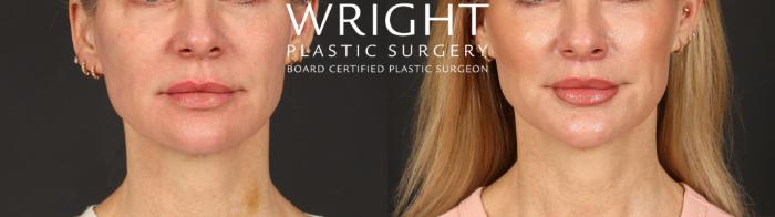 Before & After Lip Lift Case 598 Front View in Little Rock, Arkansas