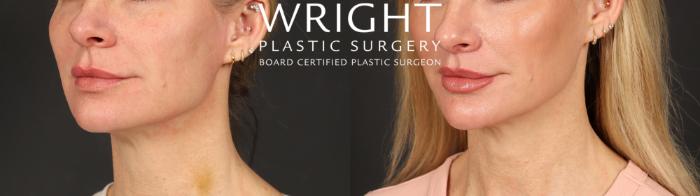 Before & After Lip Lift Case 598 Left Oblique View in Little Rock, Arkansas