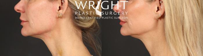 Before & After Lip Lift Case 598 Left Side View in Little Rock, Arkansas