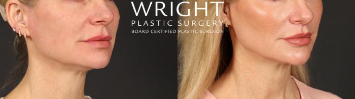 Before & After Lip Lift Case 598 Right Oblique View in Little Rock, Arkansas