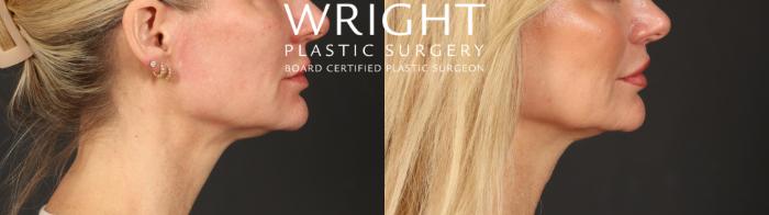 Before & After Lip Lift Case 598 Right Side View in Little Rock, Arkansas