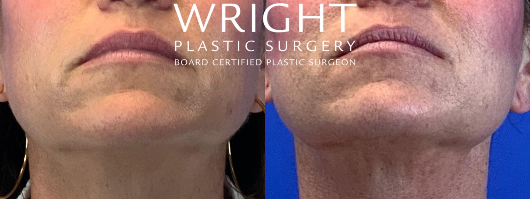 Before & After Liposuction Case 121 Chin Up View in Little Rock, Arkansas