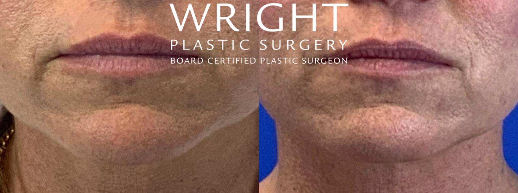 Before & After Liposuction Case 121 Front View in Little Rock, Arkansas