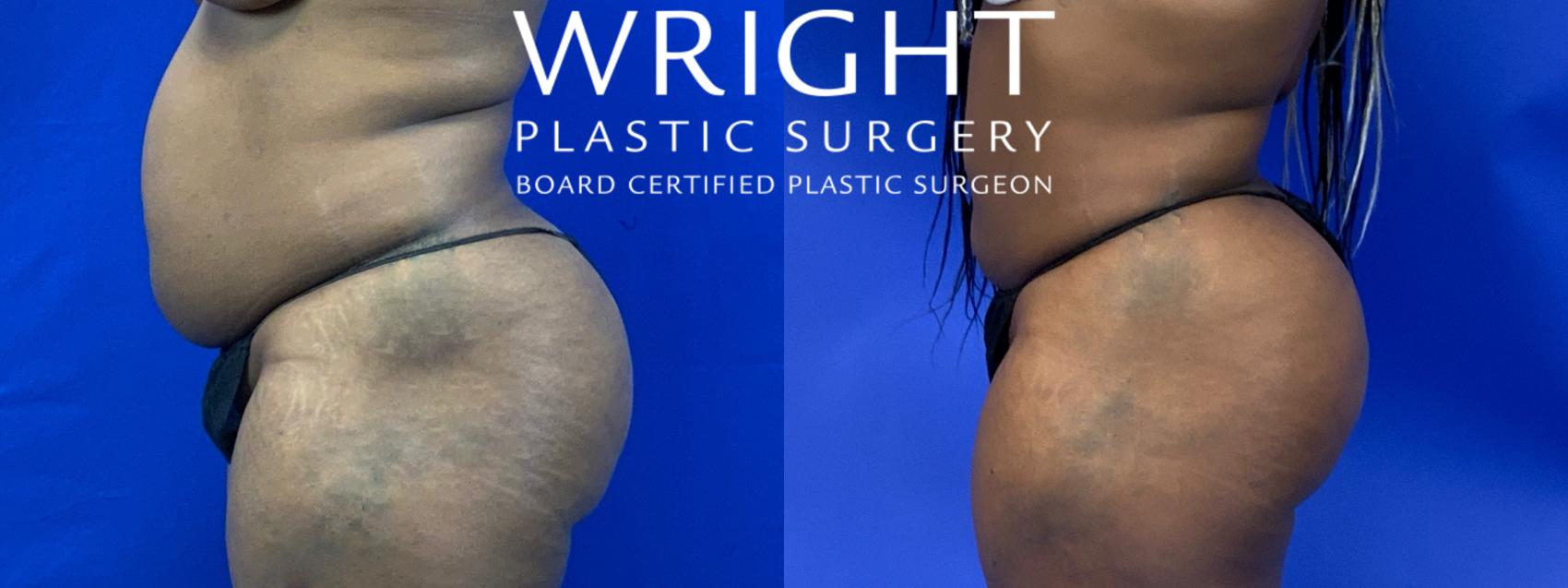 Before & After Liposuction Case 124 Left Side View in Little Rock, Arkansas
