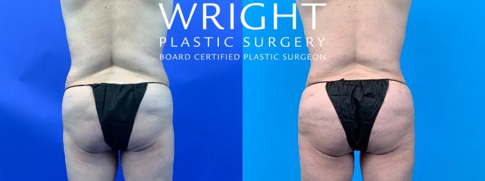 Before & After Liposuction Case 150 Back View in Little Rock, Arkansas
