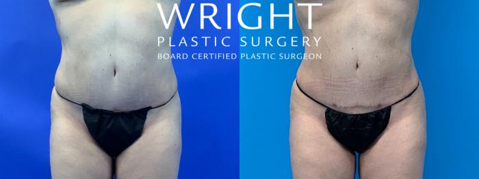 Before & After Liposuction Case 150 Front View in Little Rock, Arkansas