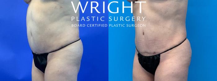 Before & After Liposuction Case 150 Left Oblique View in Little Rock, Arkansas
