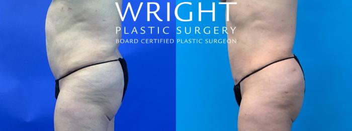 Before & After Liposuction Case 150 Left Side View in Little Rock, Arkansas