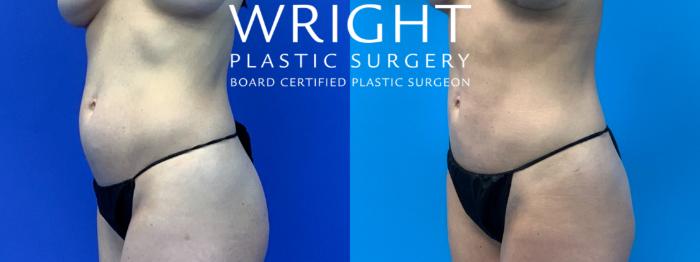 Before & After Liposuction Case 233 Left Oblique View in Little Rock, Arkansas