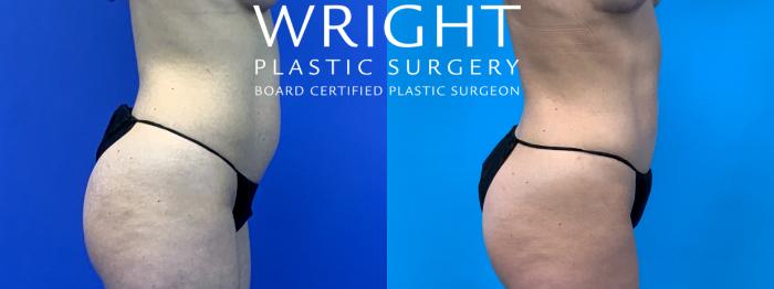 Before & After Liposuction Case 233 Right Side View in Little Rock, Arkansas