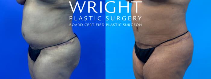 Before & After Liposuction Case 235 Left Oblique View in Little Rock, Arkansas