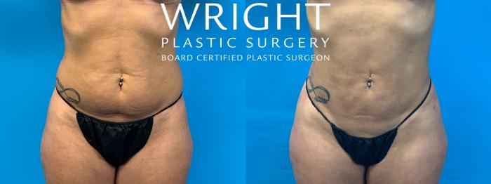 Before & After Liposuction Case 242 Front View in Little Rock, Arkansas