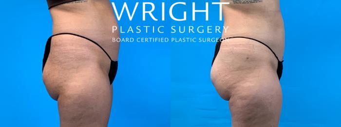 Before & After Liposuction Case 373 Right Side View in Little Rock, Arkansas