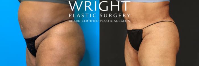 Before & After Liposuction Case 435 Left Oblique View in Little Rock, Arkansas