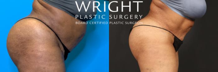 Before & After Liposuction Case 435 Right Side View in Little Rock, Arkansas