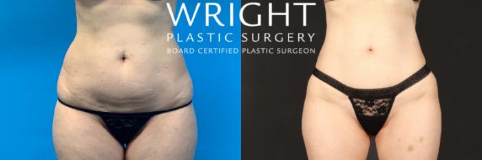 Before & After Liposuction Case 486 Front View in Little Rock, Arkansas