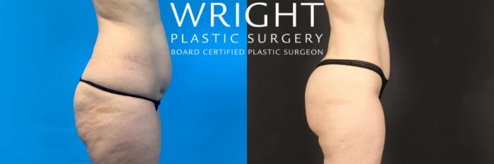 Before & After Liposuction Case 486 Right Side View in Little Rock, Arkansas
