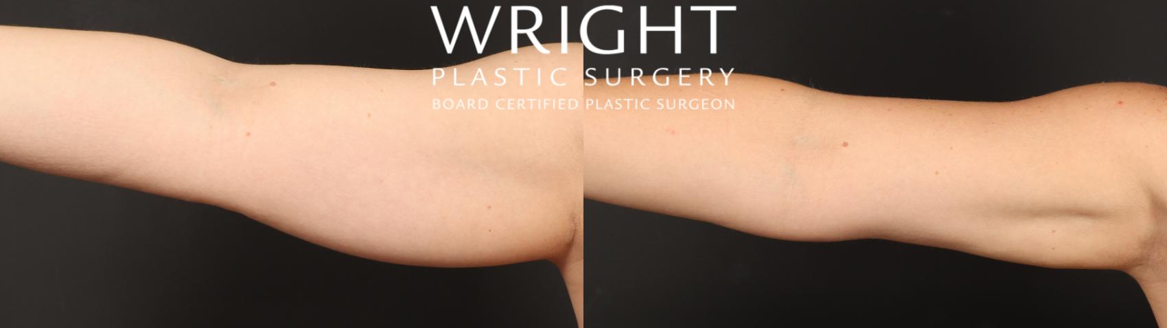 Before & After Liposuction Case 540 Front View in Little Rock, Arkansas