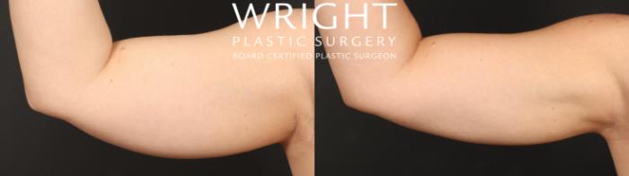 Before & After Liposuction Case 540 Left Side View in Little Rock, Arkansas