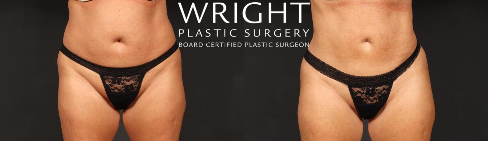 Before & After Liposuction Case 545 Front View in Little Rock, Arkansas