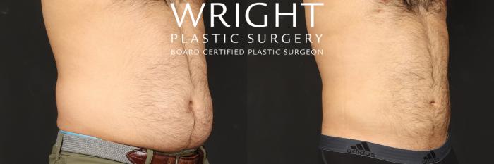 Before & After Liposuction Case 565 Right Oblique View in Little Rock, Arkansas