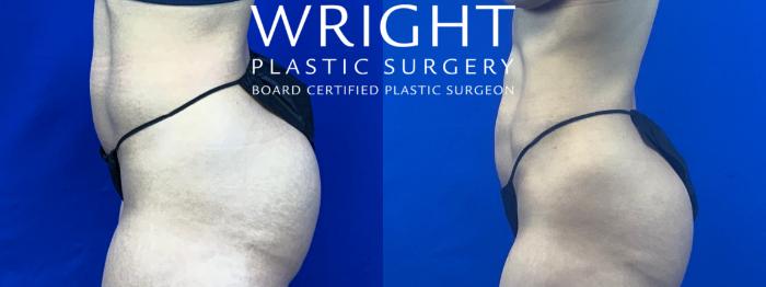 Before & After Liposuction Case 59 Left Side View in Little Rock, Arkansas