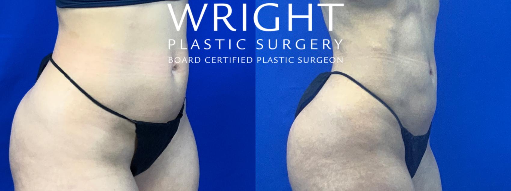 Before & After Liposuction Case 59 Right Oblique View in Little Rock, Arkansas