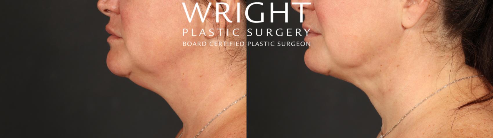 Before & After Liposuction Case 611 Left Side View in Little Rock, Arkansas