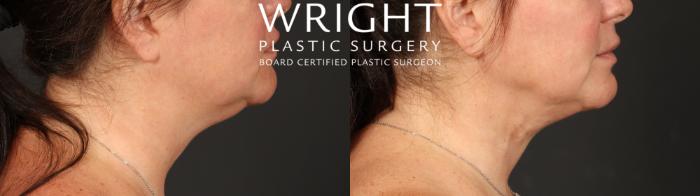 Before & After Liposuction Case 611 Right Side View in Little Rock, Arkansas