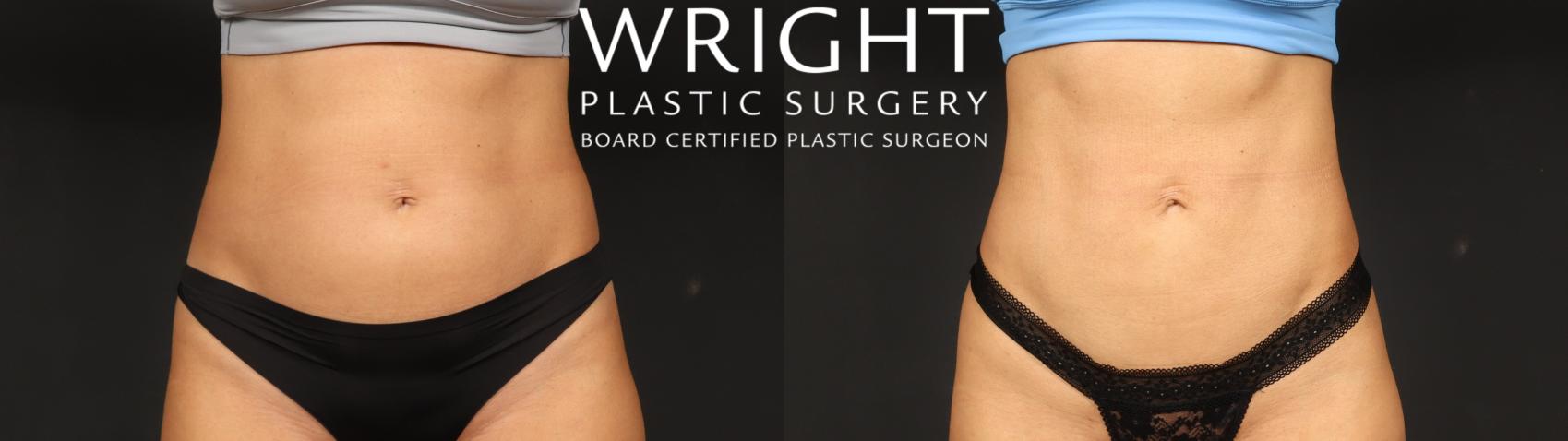 Before & After Liposuction Case 636 Front View in Little Rock, Arkansas