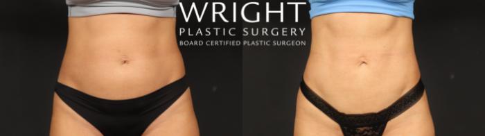 Before & After Liposuction Case 636 Front View in Little Rock, Arkansas