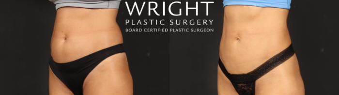 Before & After Liposuction Case 636 Left Oblique View in Little Rock, Arkansas