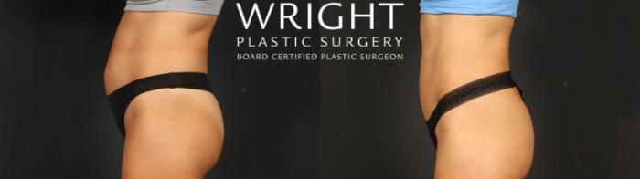 Before & After Liposuction Case 636 Left Side View in Little Rock, Arkansas